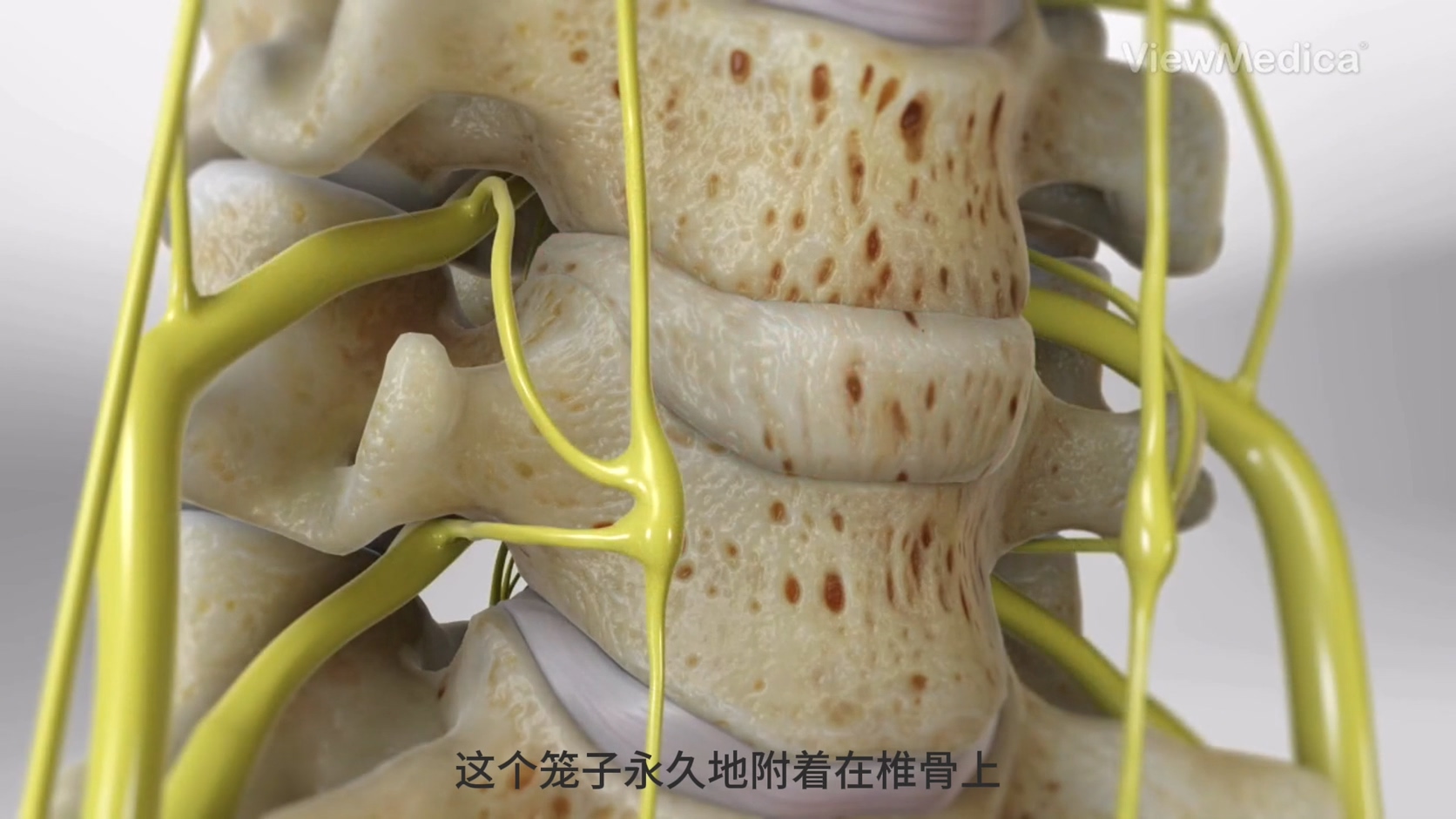 颈椎板切除术（颈椎融合器）3D演示安装过程