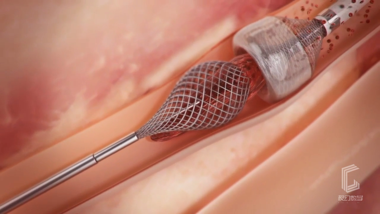 心脏支架手术医疗动画展示片