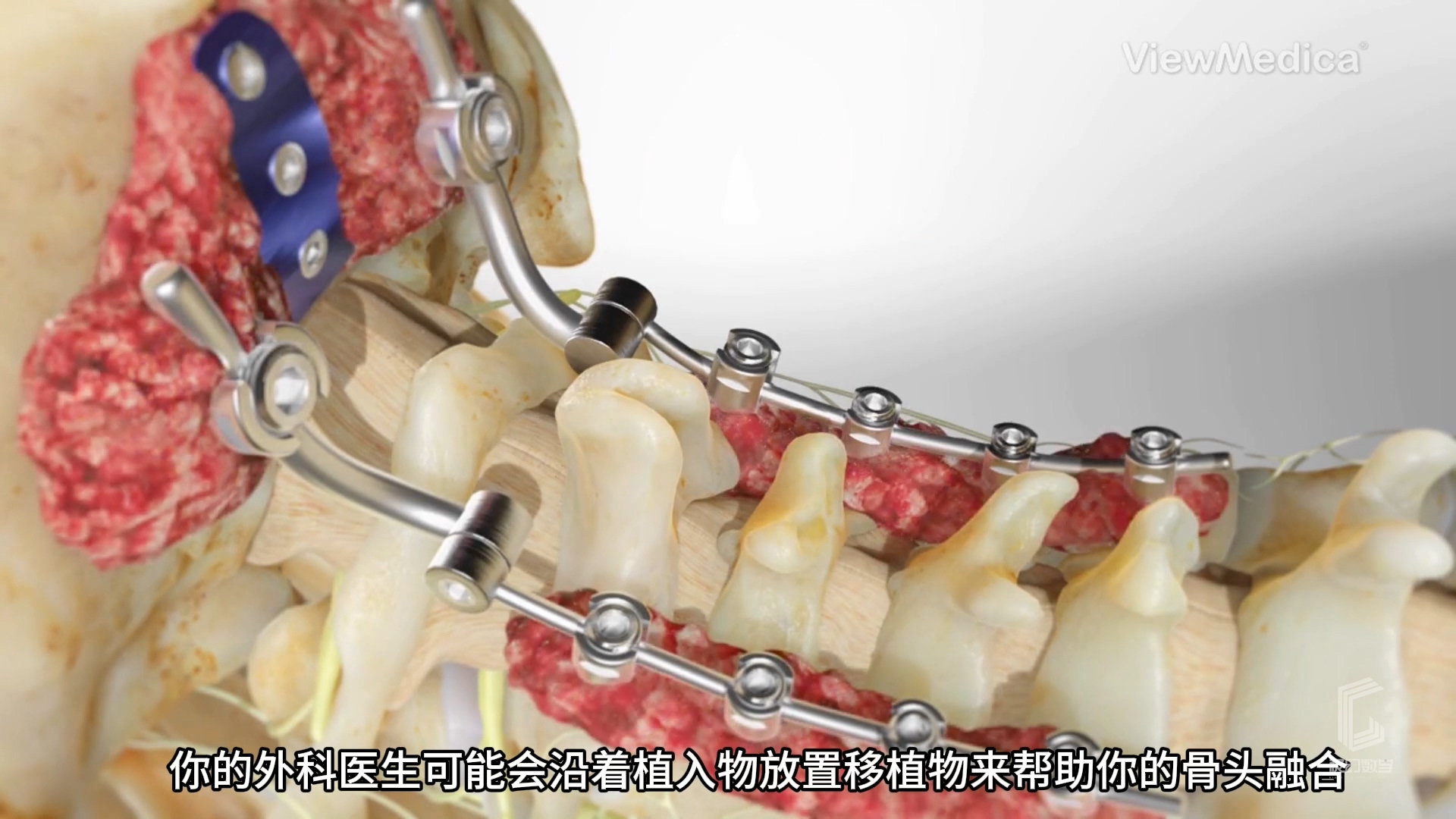 枕颈固定（OC融合术）-医疗3...